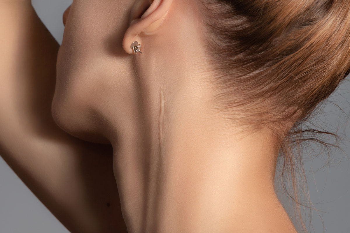 Narben – wann und wie man sie behandeln sollte