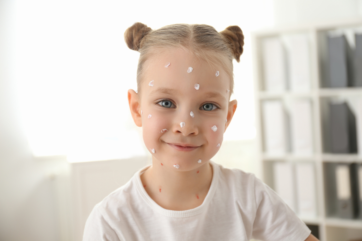 Kinderkrankheiten: Was zu tun ist bei Windpocken und Masern