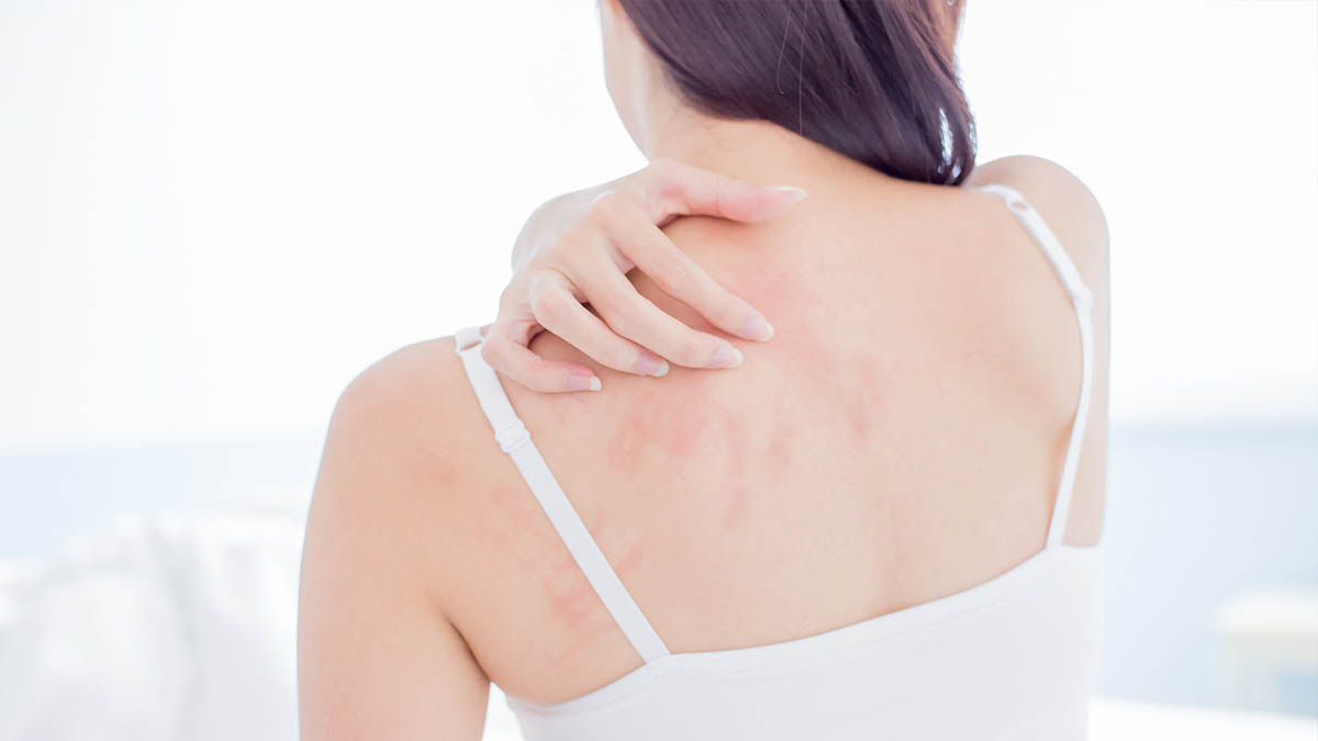 Neurodermitis im Sommer – zu jeder Jahreszeit ideal beraten